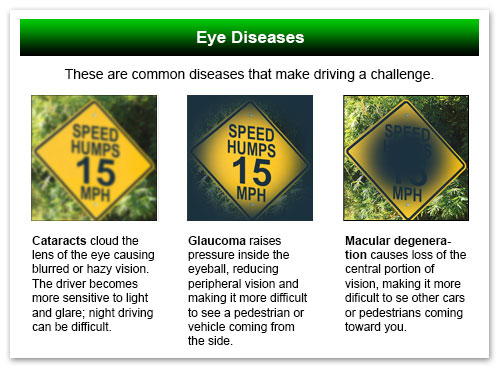 Eye Diseases